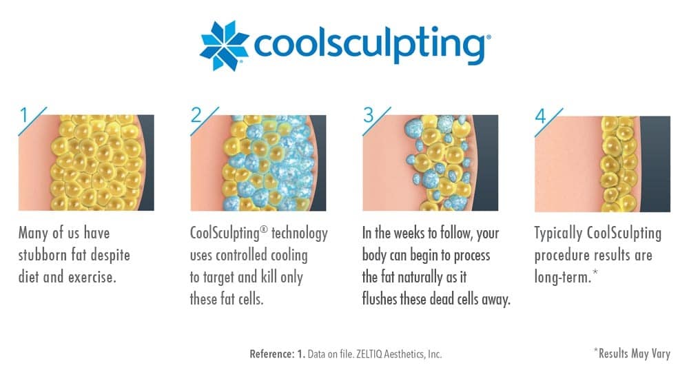 CoolSculpting®