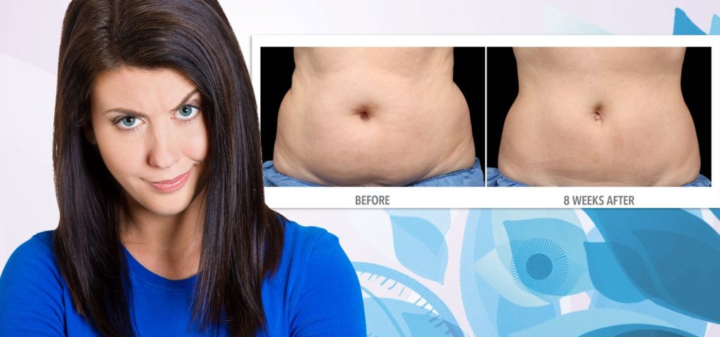 does coolsculpting really work