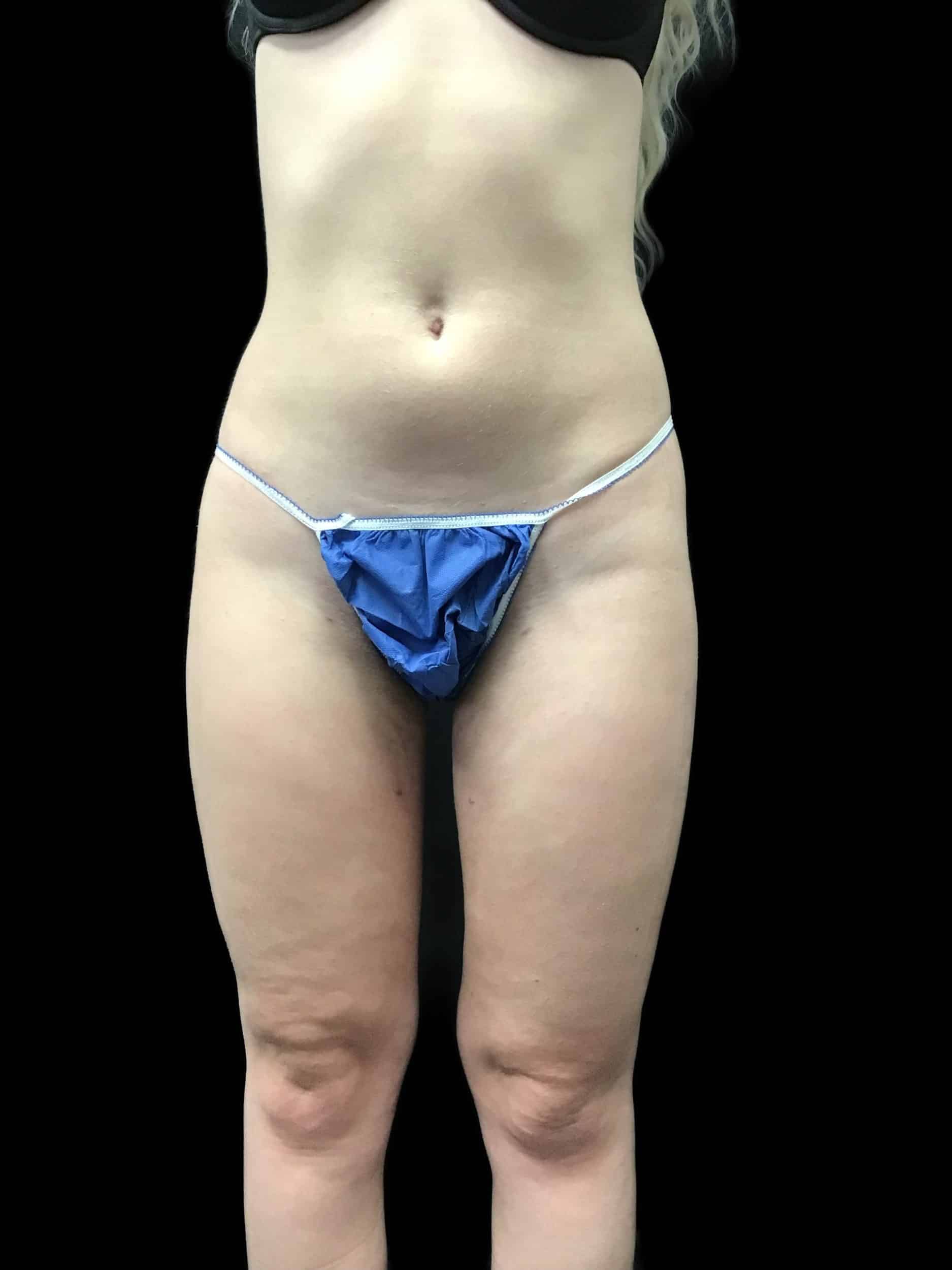 Liposuction – Inner Thighs