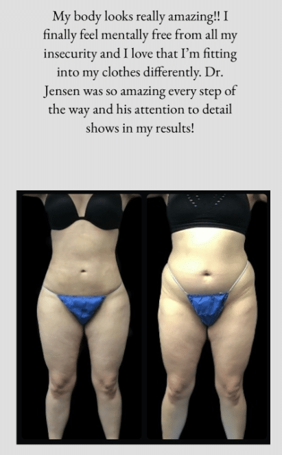 liposuction image